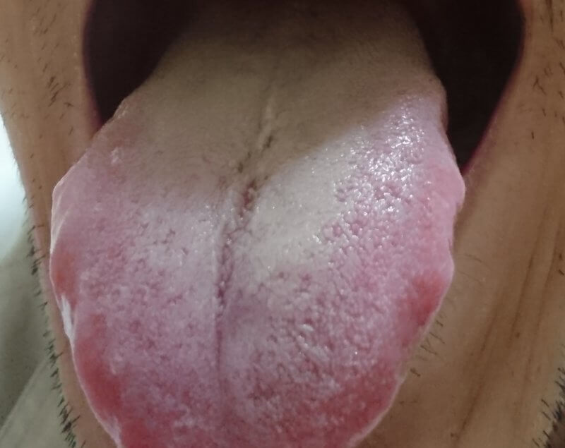 白い舌苔